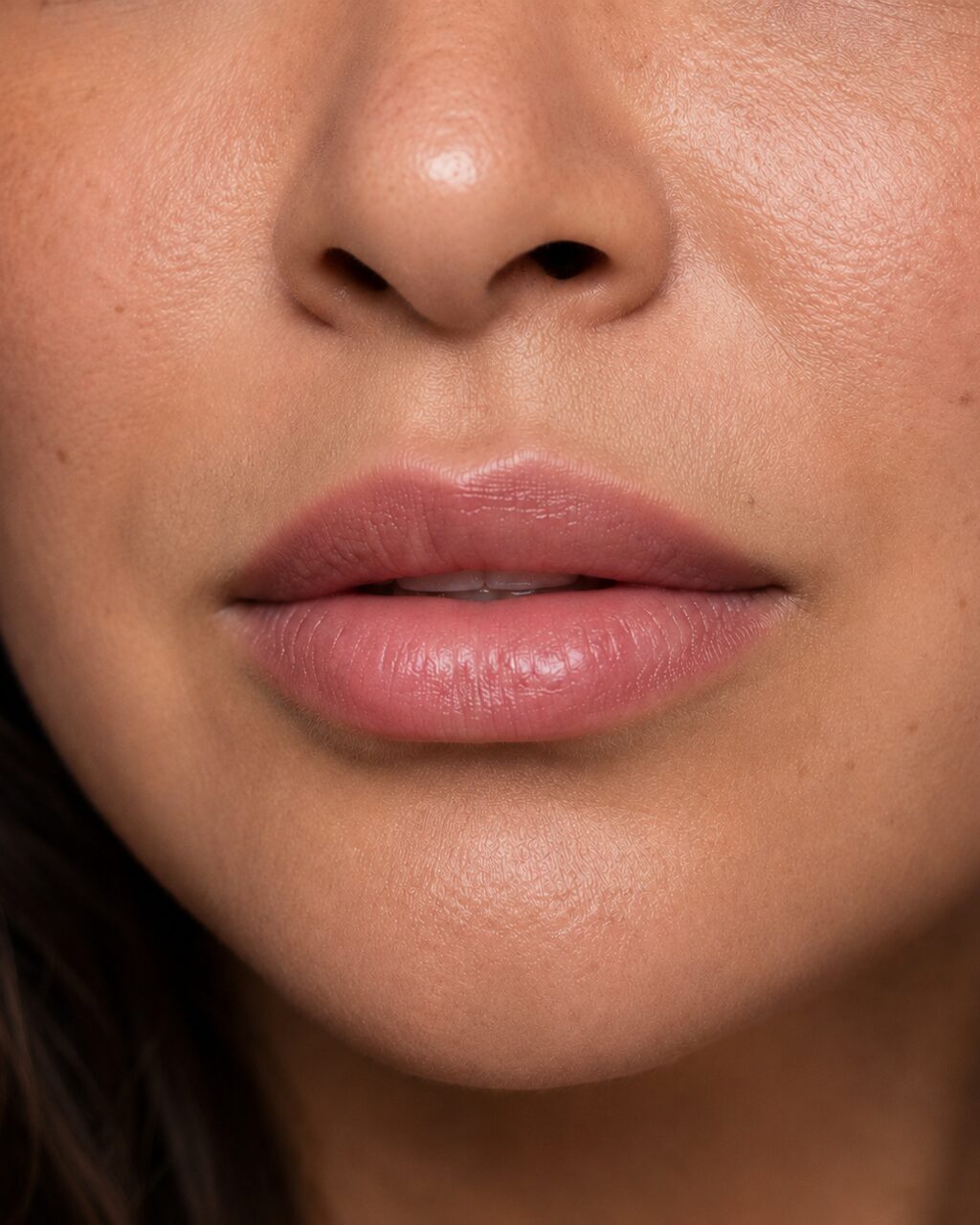 Restylane® Hyaluronic Acid — Vita Aesthetics, Whittier